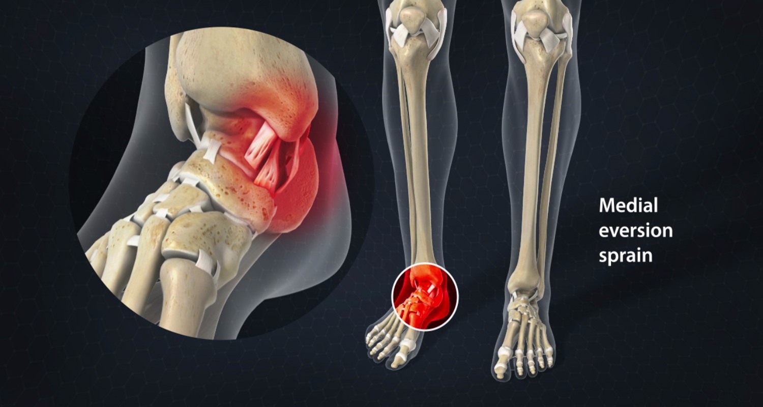 Soft Tissue Injury